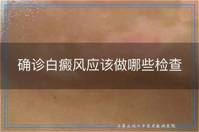 确诊白癜风应该做哪些检查
