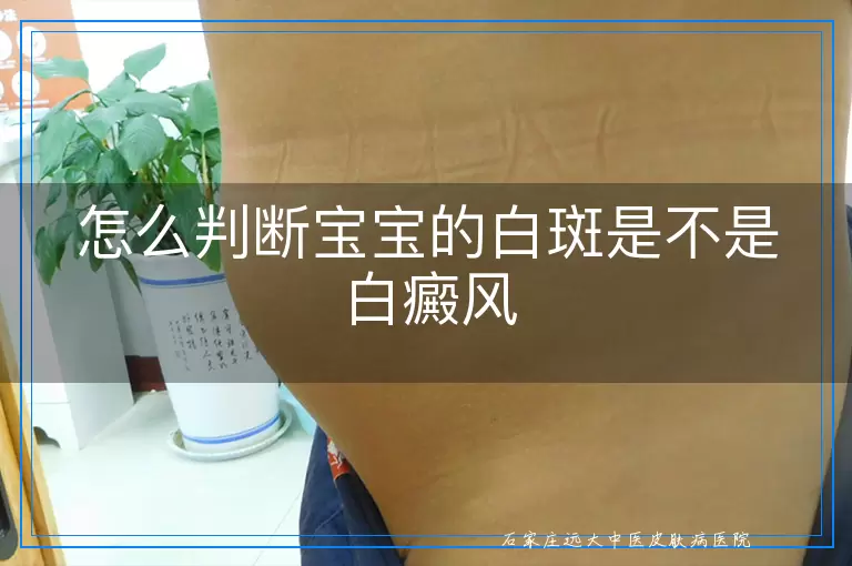 怎么判断宝宝的白斑是不是白癜风