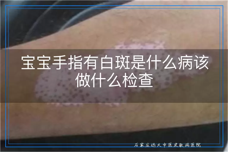 宝宝手指有白斑是什么病该做什么检查