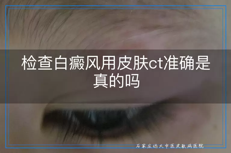 检查白癜风用皮肤ct准确是真的吗