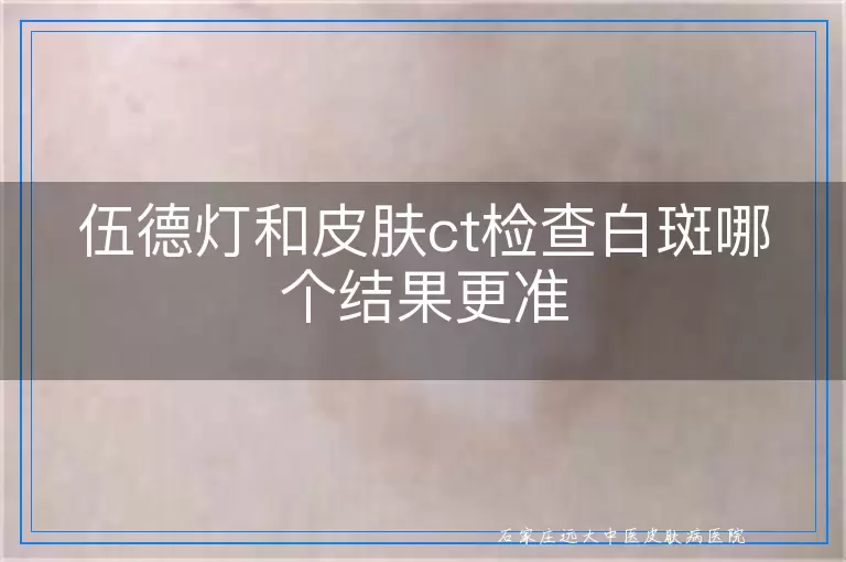 伍德灯和皮肤ct检查白斑哪个结果更准