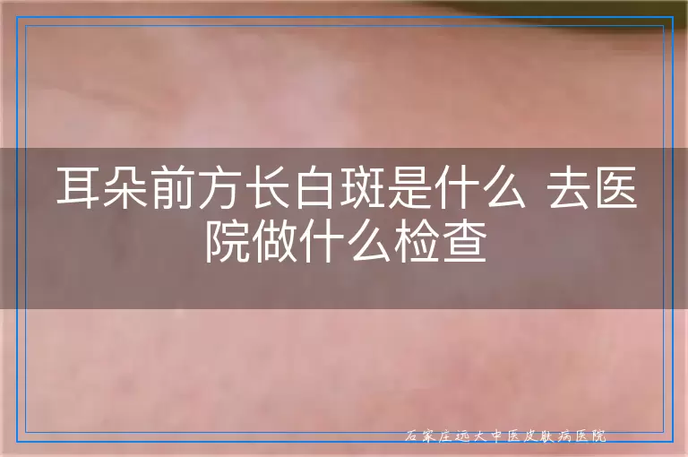 耳朵前方长白斑是什么 去医院做什么检查