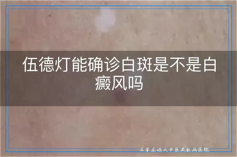 伍德灯能确诊白斑是不是白癜风吗