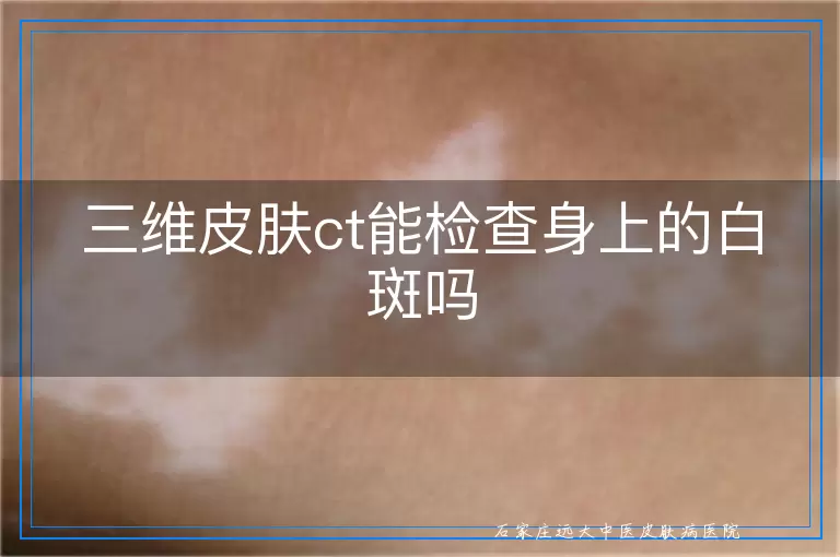 三维皮肤ct能检查身上的白斑吗