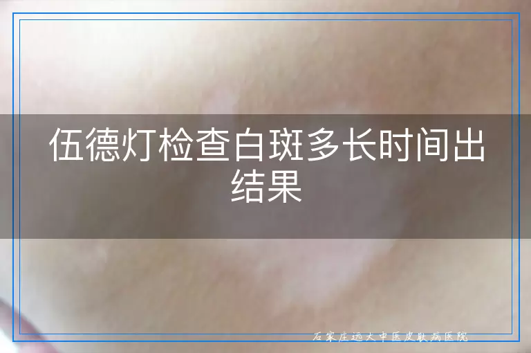 伍德灯检查白斑多长时间出结果