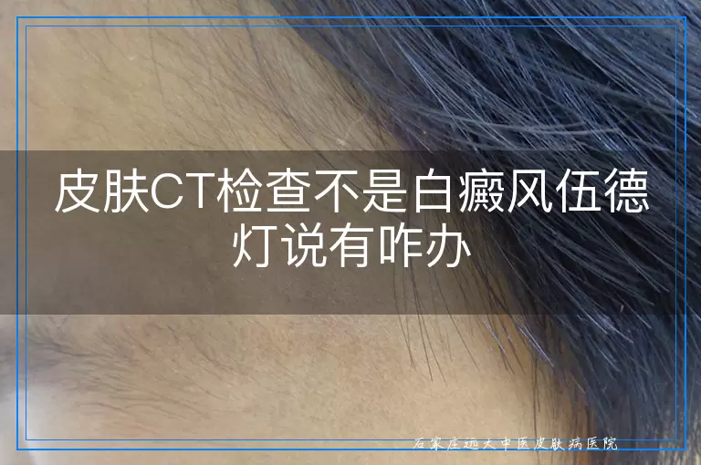 皮肤CT检查不是白癜风伍德灯说有咋办