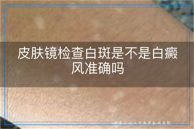 皮肤镜检查白斑是不是白癜风准确吗