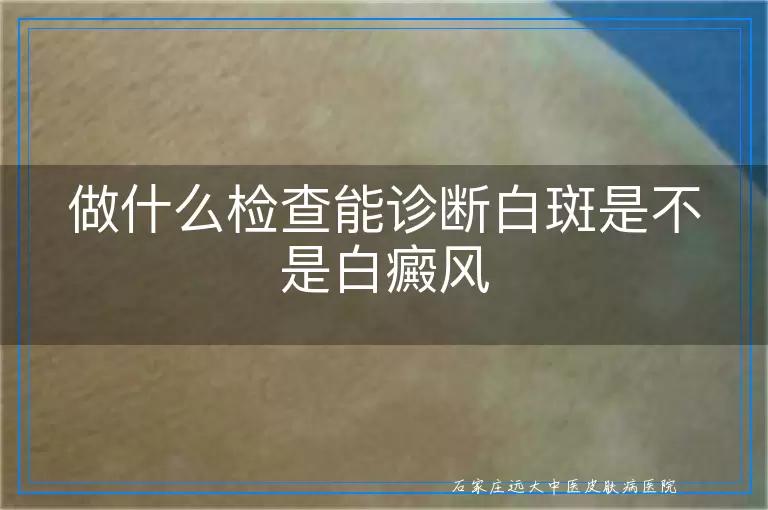 做什么检查能诊断白斑是不是白癜风