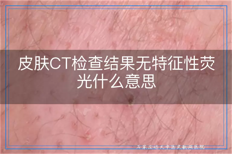 皮肤CT检查结果无特征性荧光什么意思