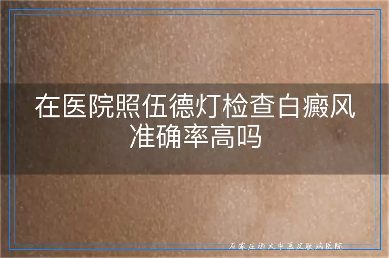 在医院照伍德灯检查白癜风准确率高吗