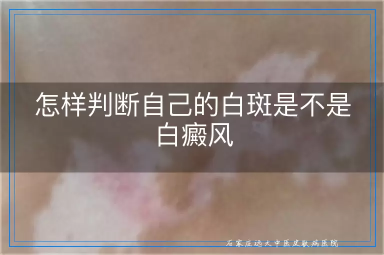 怎样判断自己的白斑是不是白癜风