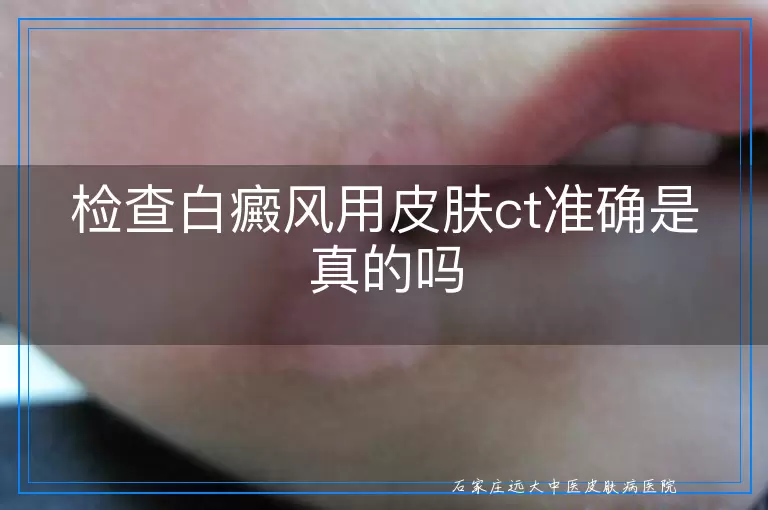 检查白癜风用皮肤ct准确是真的吗