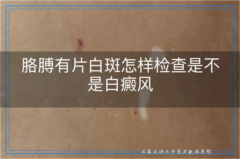 胳膊有片白斑怎样检查是不是白癜风