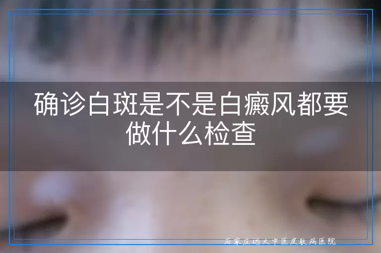 确诊白斑是不是白癜风都要做什么检查