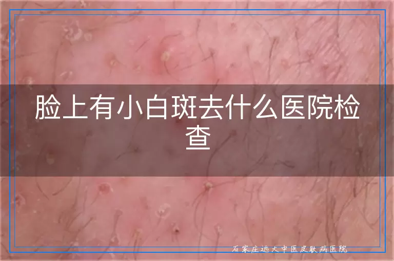 脸上有小白斑去什么医院检查