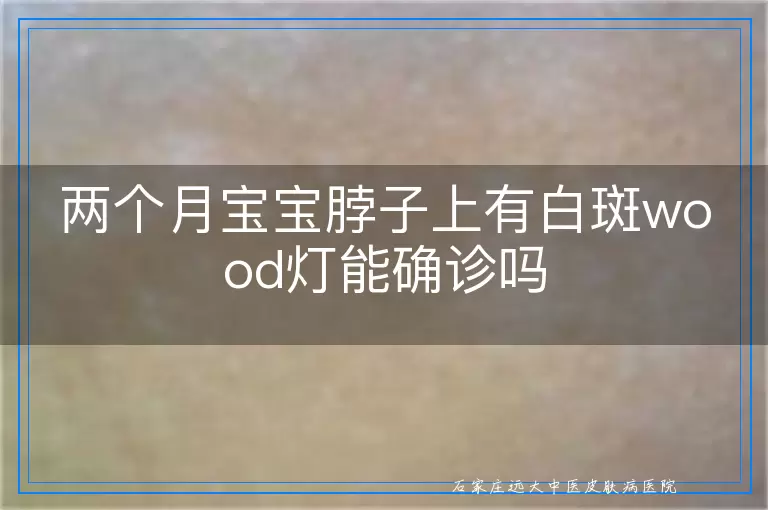 两个月宝宝脖子上有白斑wood灯能确诊吗