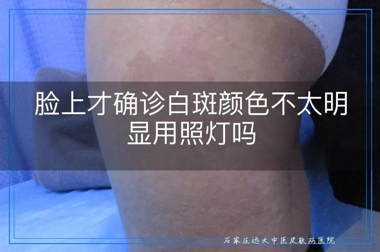 脸上才确诊白斑颜色不太明显用照灯吗