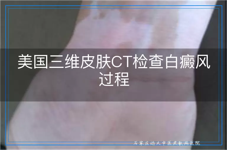 美国三维皮肤CT检查白癜风过程