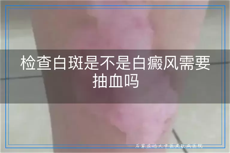 检查白斑是不是白癜风需要抽血吗