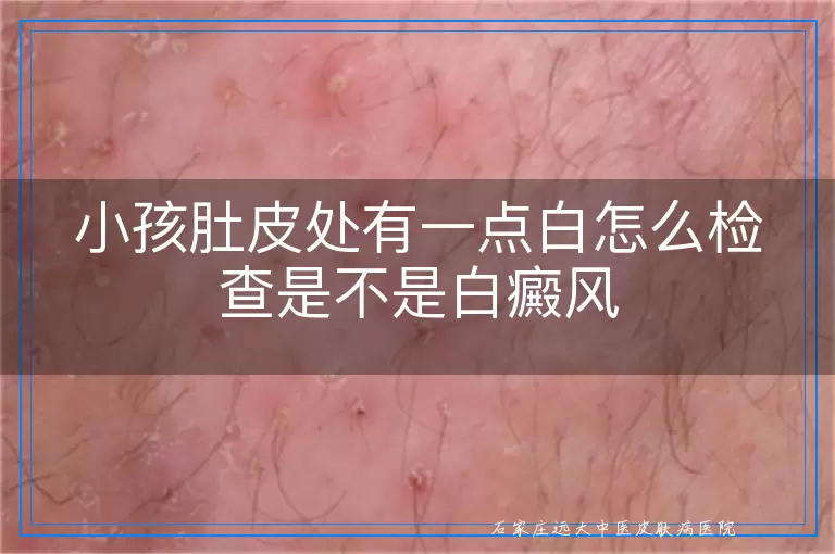 小孩肚皮处有一点白怎么检查是不是白癜风