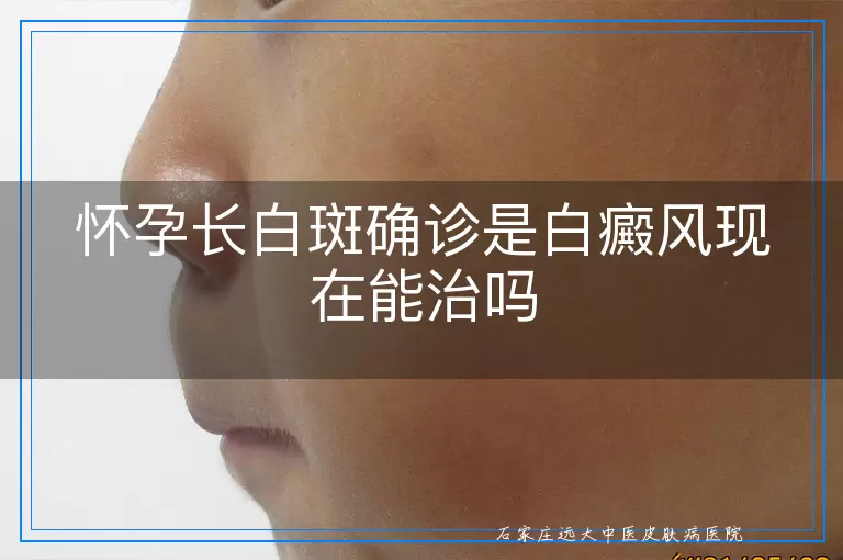 怀孕长白斑确诊是白癜风现在能治吗