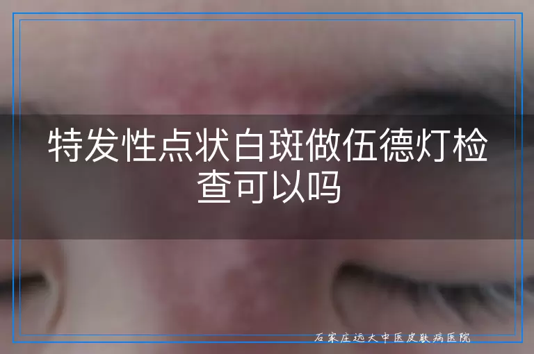 特发性点状白斑做伍德灯检查可以吗