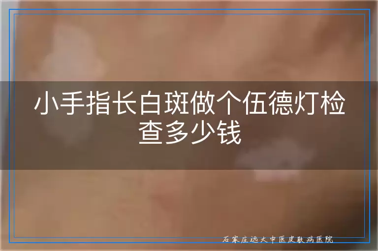 小手指长白斑做个伍德灯检查多少钱