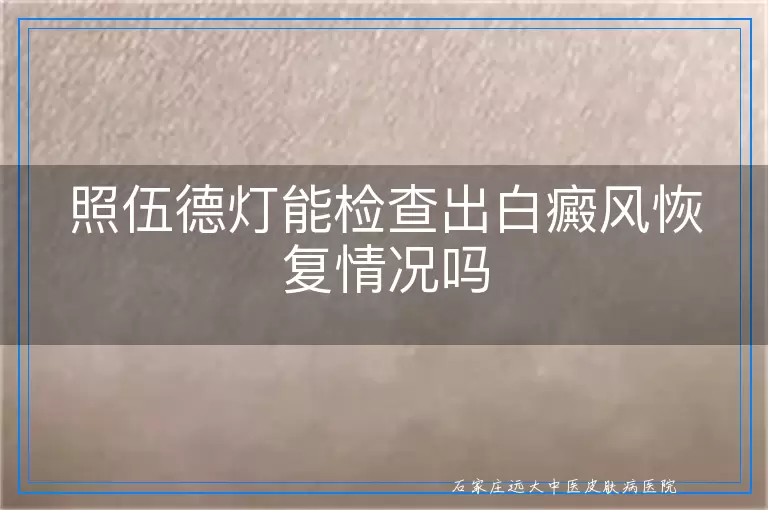 照伍德灯能检查出白癜风恢复情况吗