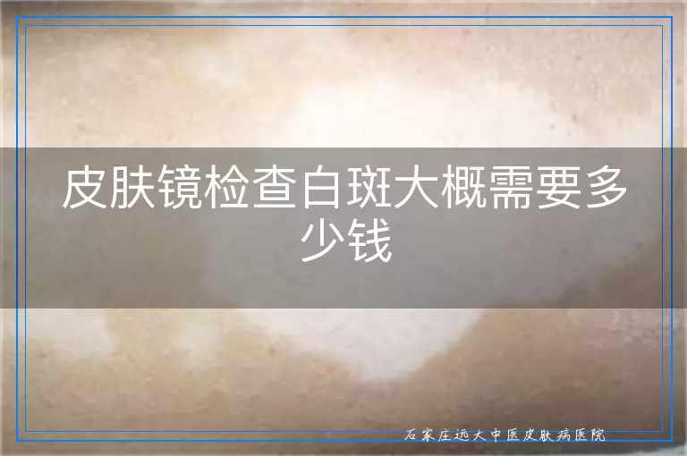 皮肤镜检查白斑大概需要多少钱