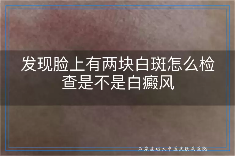 发现脸上有两块白斑怎么检查是不是白癜风