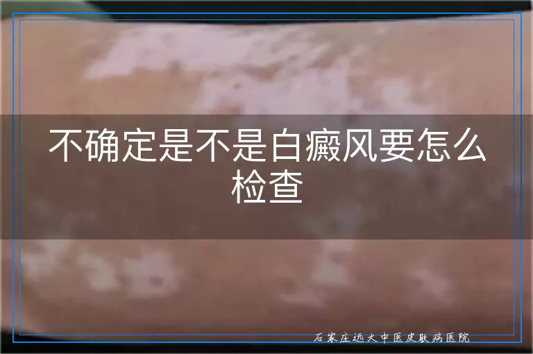 不确定是不是白癜风要怎么检查