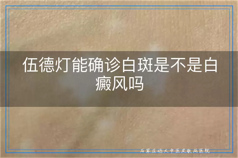 伍德灯能确诊白斑是不是白癜风吗