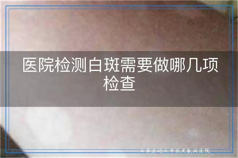 医院检测白斑需要做哪几项检查