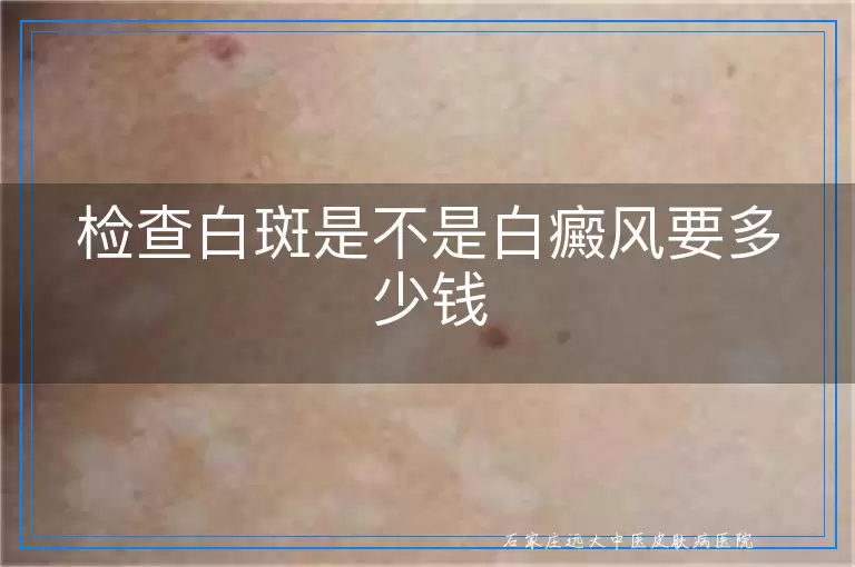 检查白斑是不是白癜风要多少钱