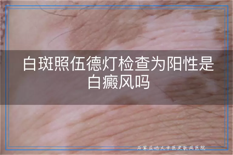 白斑照伍德灯检查为阳性是白癜风吗