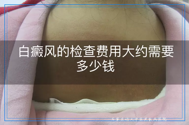 白癜风的检查费用大约需要多少钱