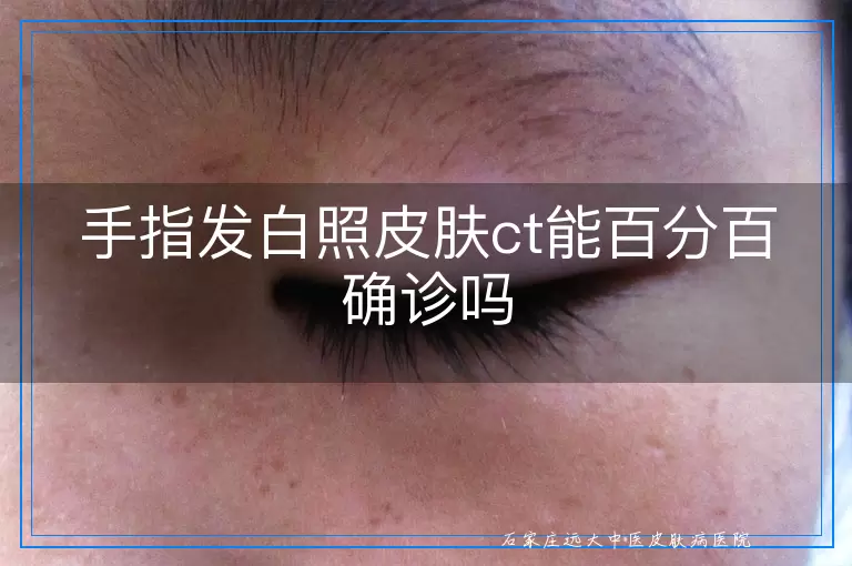 手指发白照皮肤ct能百分百确诊吗