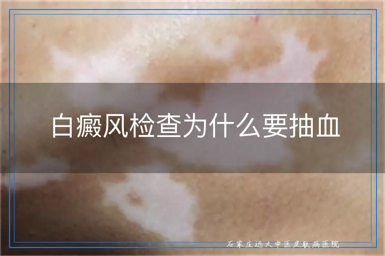 白癜风检查为什么要抽血