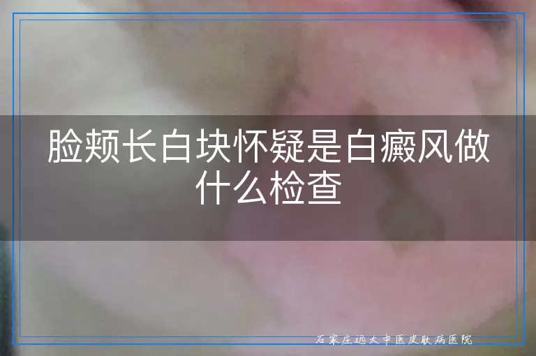 脸颊长白块怀疑是白癜风做什么检查