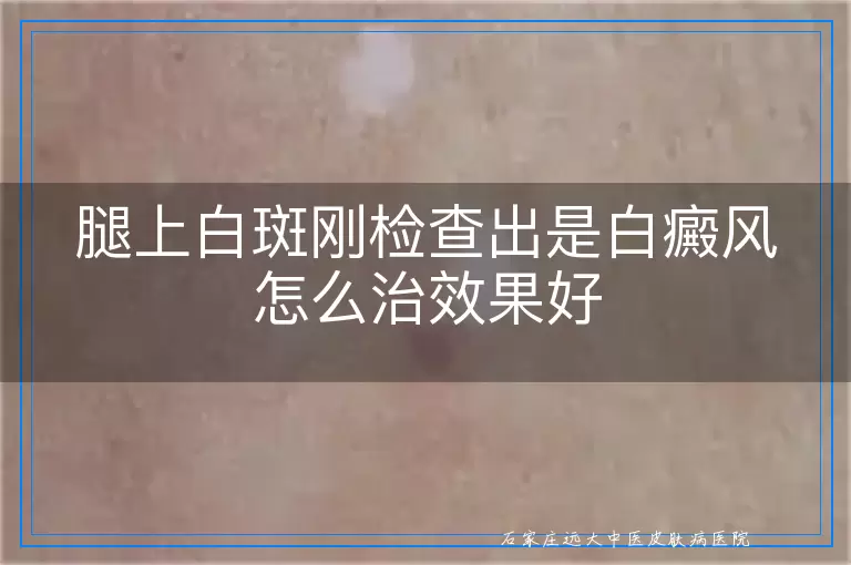 腿上白斑刚检查出是白癜风怎么治效果好