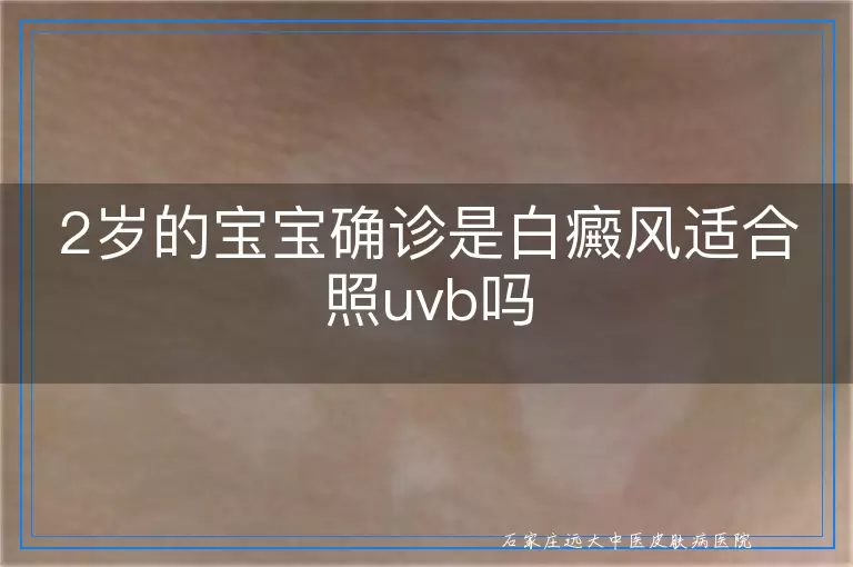 2岁的宝宝确诊是白癜风适合照uvb吗