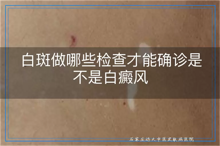 白斑做哪些检查才能确诊是不是白癜风