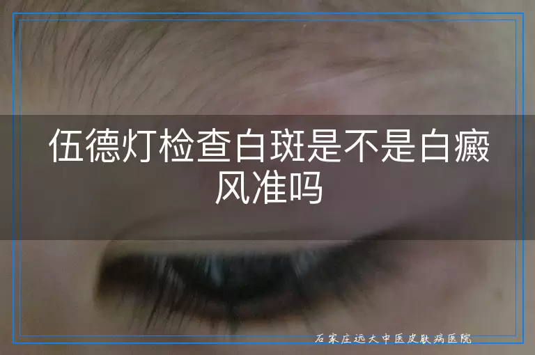伍德灯检查白斑是不是白癜风准吗