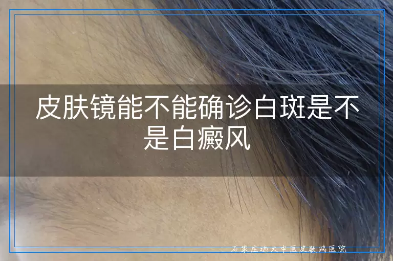 皮肤镜能不能确诊白斑是不是白癜风