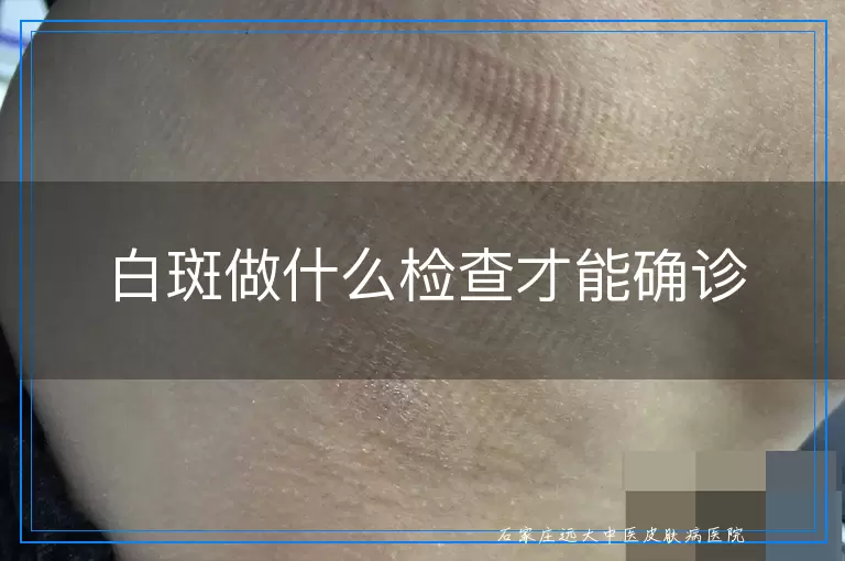 白斑做什么检查才能确诊