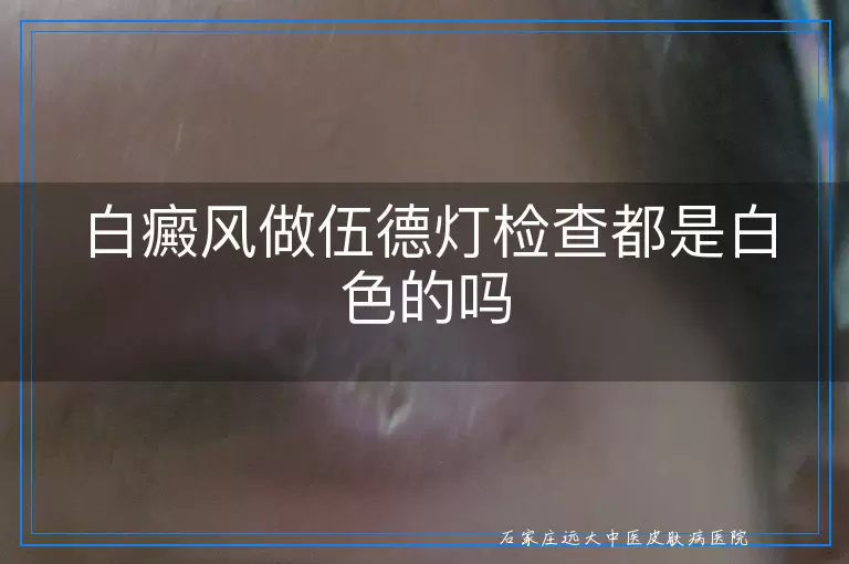 白癜风做伍德灯检查都是白色的吗