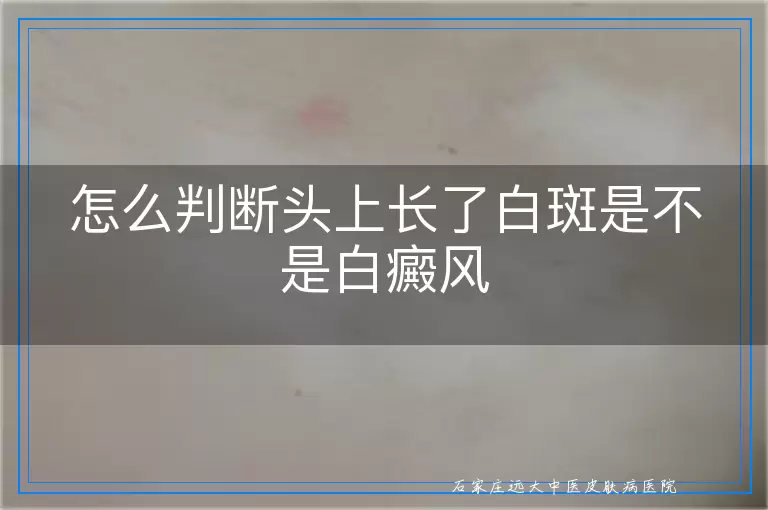 怎么判断头上长了白斑是不是白癜风
