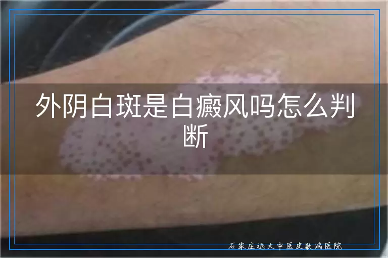 外阴白斑是白癜风吗怎么判断