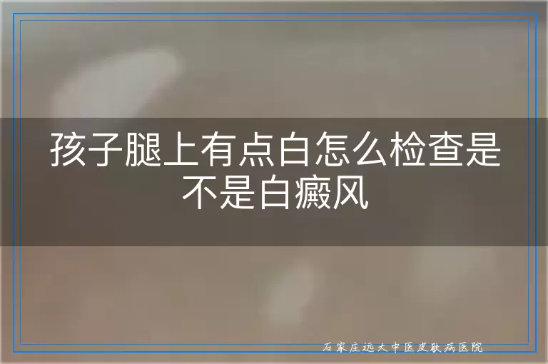 孩子腿上有点白怎么检查是不是白癜风