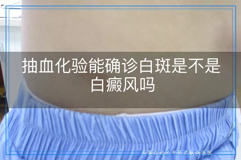 抽血化验能确诊白斑是不是白癜风吗